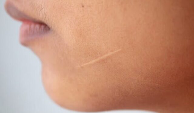 از بین بردن جای زخم با پیوند فولیکول مو