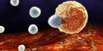 مبارزه با سرطان با کاشت اسفنج در کنار تومور!